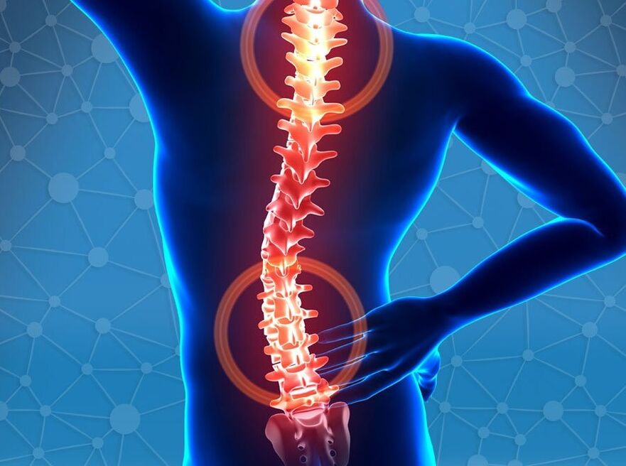 osteocondrosis de la columna