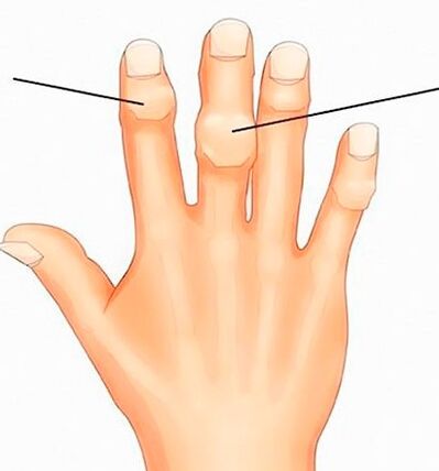 Nódulos de Heberden y Bouchard en las articulaciones interfalángicas con artrosis