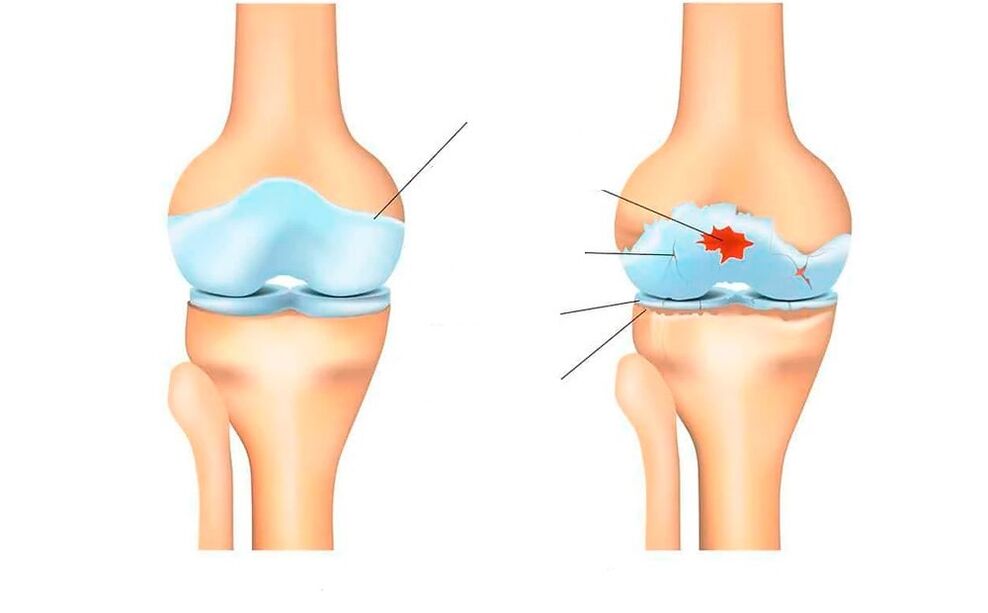 articulación sana y con artrosis