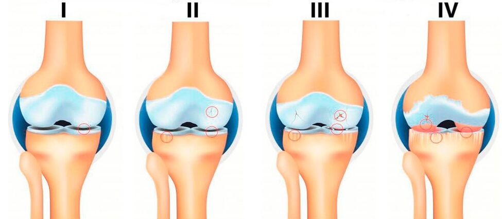 etapas de la artrosis