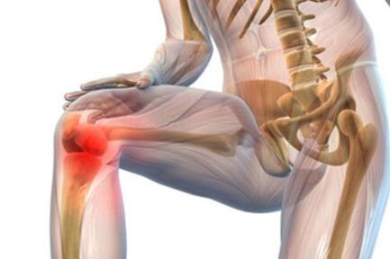Artrosis de la articulación de la rodilla