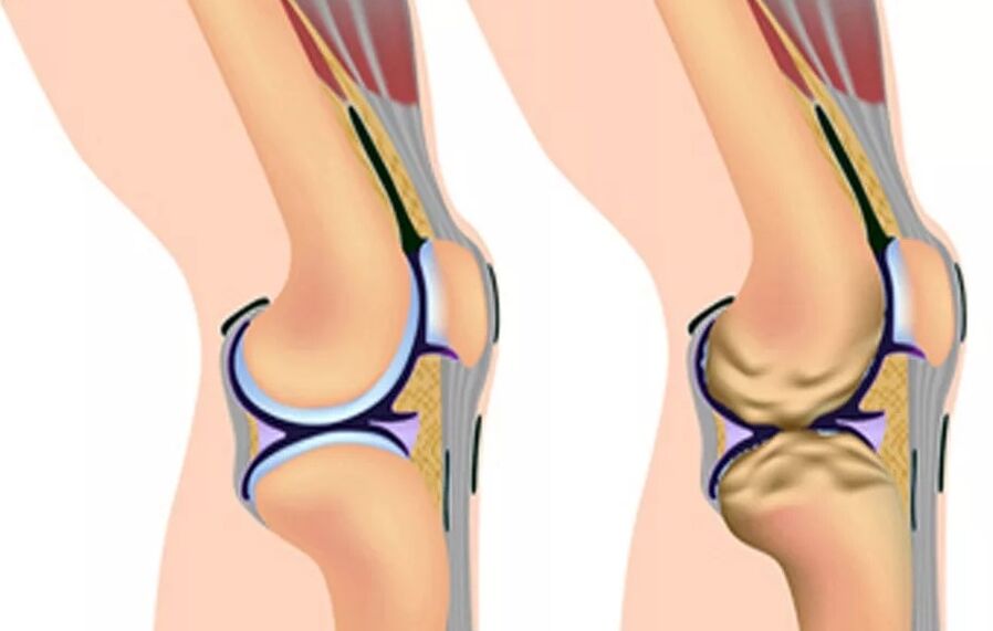 El primer grado de artrosis de rodilla
