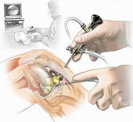 Operación en la articulación de la rodilla - Artroscopia
