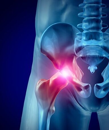 dolor de cadera foto 1