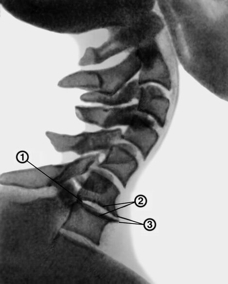 Radiografía de la columna cervical con osteocondrosis.