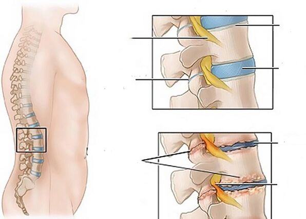 Cambios en los discos debido a la osteocondrosis.