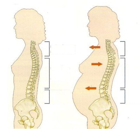 osteocondrosis durante el embarazo