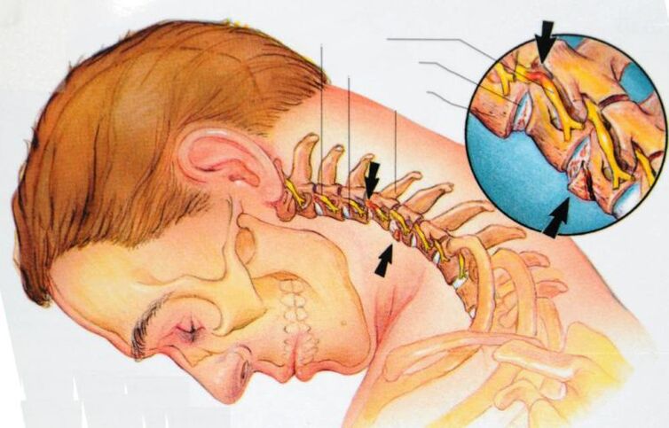 síntomas de osteocondrosis cervical