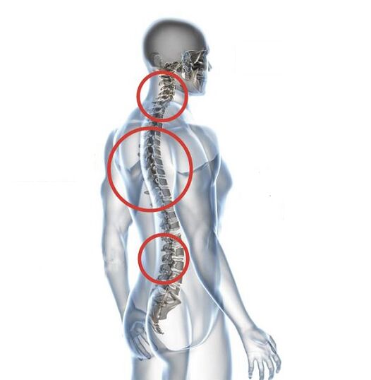 ¿Cómo se manifiesta la osteocondrosis