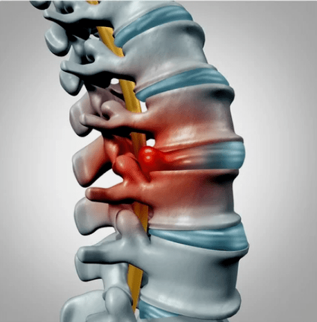 Protencia de los discos intervertebrales